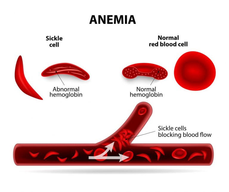 How anemia works